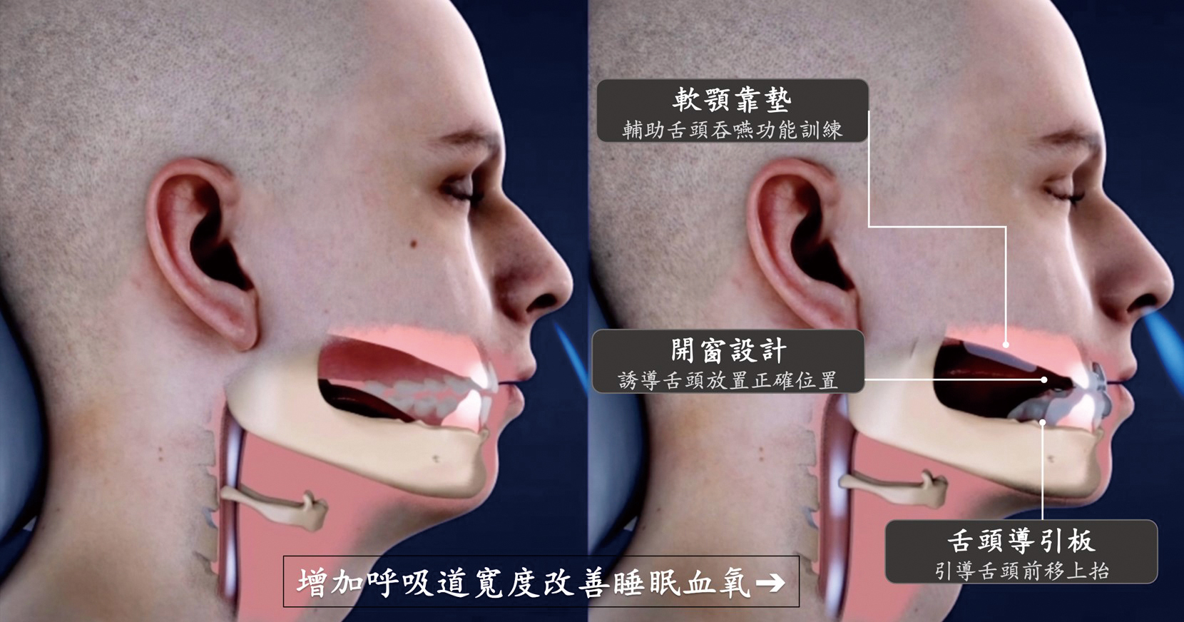 創新止鼾牙套特色與功能